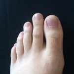 Photo_of_Morton's_Toe.jpg