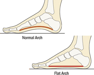 flat-feet-arch-pain.jpg